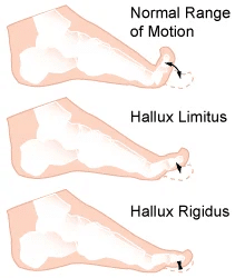 Graphic displaying the range of motion of Hallux Limitus. Normal range of motion, Hallux Limitus and Hallux Rigidus