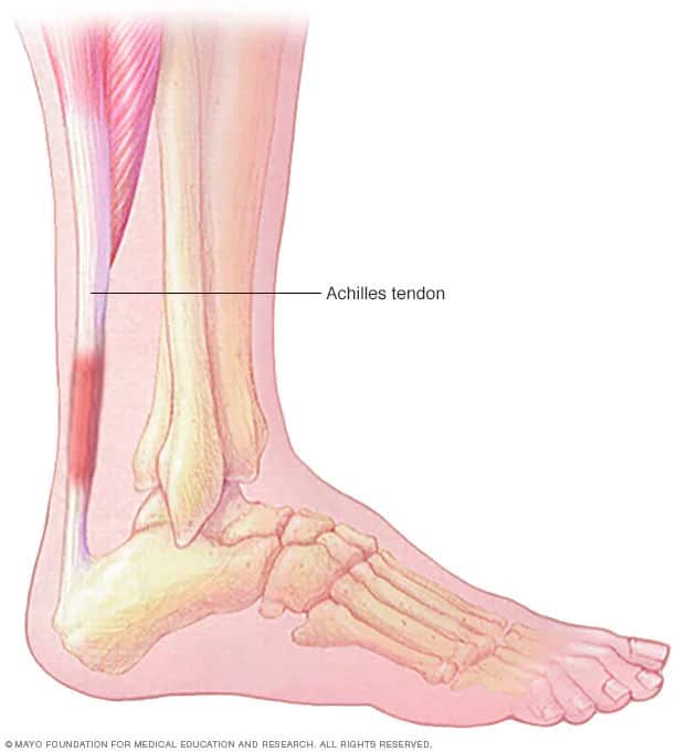 Graphic outlining and showing where Achilles tendonitis affects a person's foot